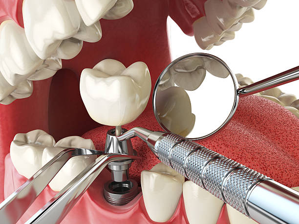 Best Knocked-Out Tooth (Avulsed Tooth) Treatment in Choctaw, OK